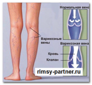 Какие уколы часто используют от болезней вен?